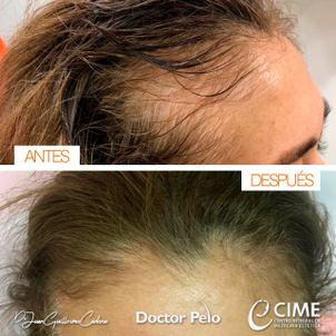 antes y despues de implante de cabello