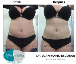 Aplicación carboxiterapia