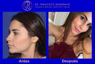 antes y después bichectomía