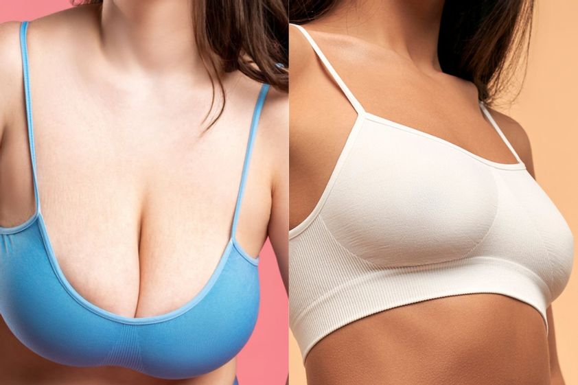 Mamoplastia de reducción