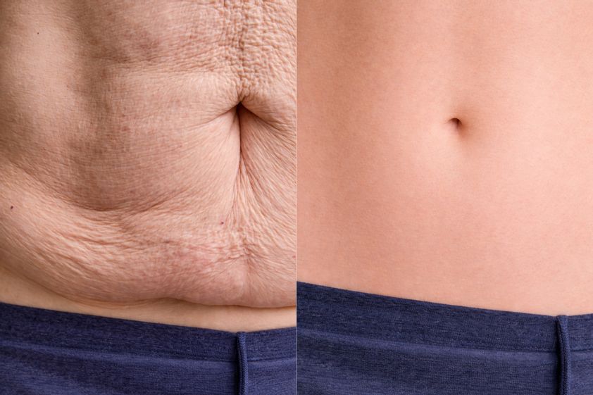 Abdominoplastia