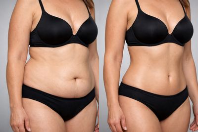 Antes y después de Lipólisis láser