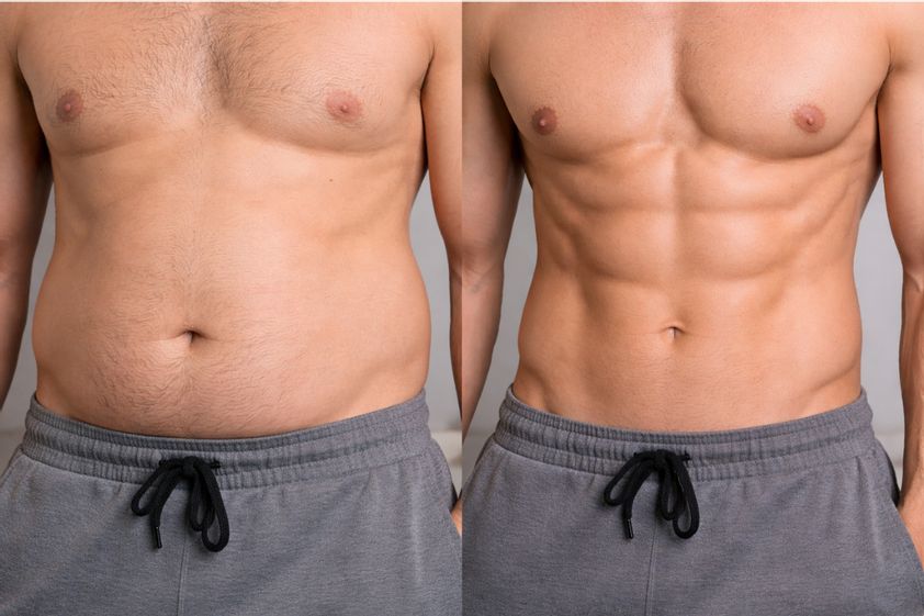 Lipoescultura