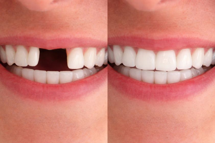 Implantes dentales