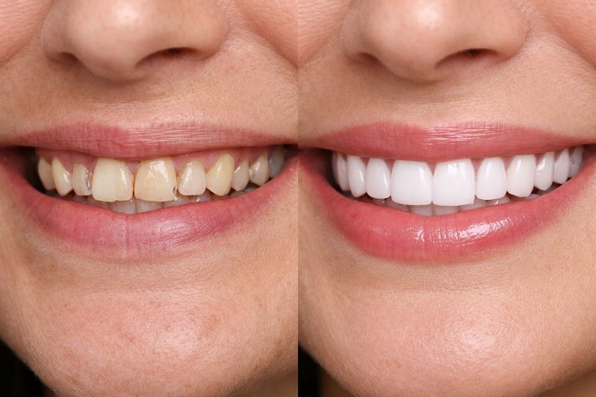 Diseño de sonrisa