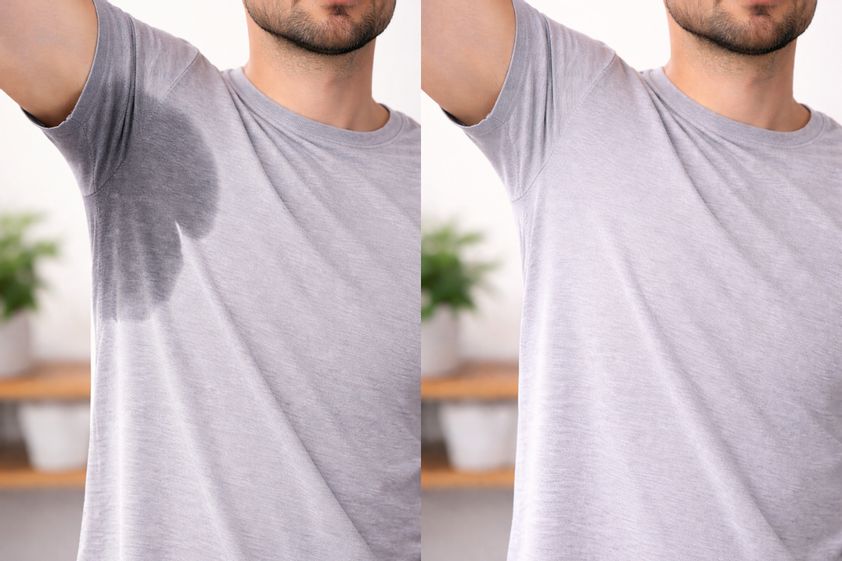 Hiperhidrosis