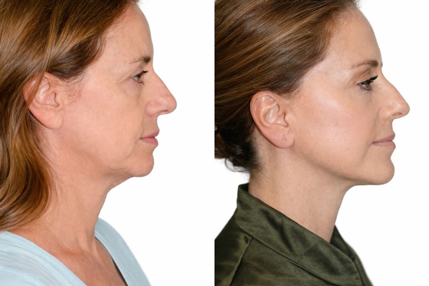 Lifting facial