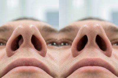 Antes y después de Septoplastia