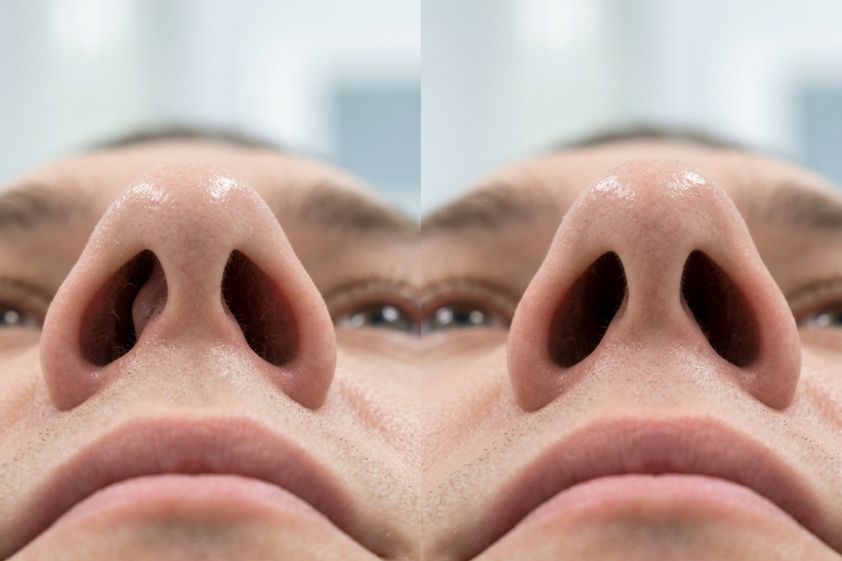 Septoplastia