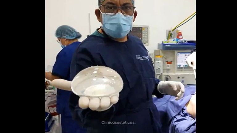 Mamoplastia de aumento - Dr. Victor Hugo Quevedo