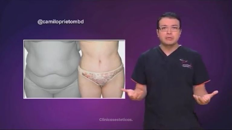 Abdominoplastia