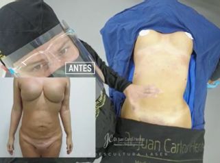 Lipoescultura - Dr. Juan Carlos Herrera P.
