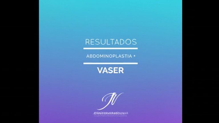 Abdominoplastia + Vaser - Dra. Jennifer Vera Bolívar
