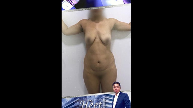 Lipoescultura - Dr. Jarold Effer Taylor