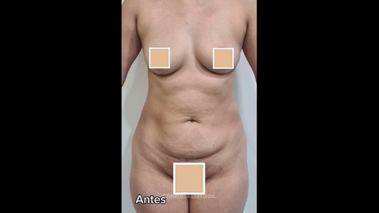 Lipoescultura - Dra. Paola León