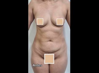 Lipoescultura - Dra. Paola León