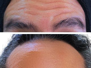 Toxina Botulínica - Doctora Alexandra Mora