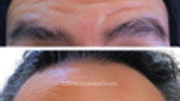 Toxina Botulínica - Doctora Alexandra Mora