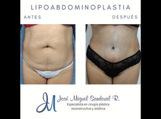 Lipoabdominoplastia - Dr. José Miguel Sandoval Rodríguez