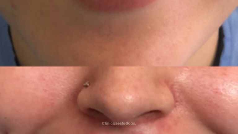Relleno de Labios - Doctora Alexandra Mora