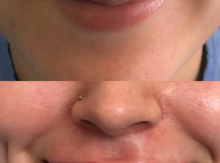 Relleno de Labios - Doctora Alexandra Mora