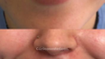 Relleno de Labios - Doctora Alexandra Mora