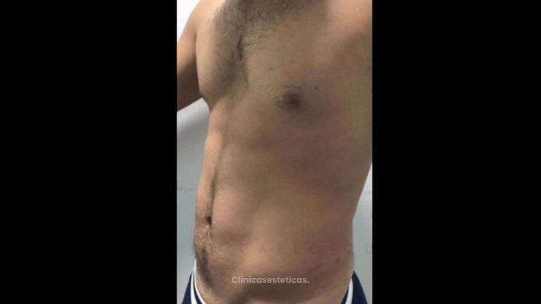 Liposucción - Dr. Carlos Zuleta Bechara