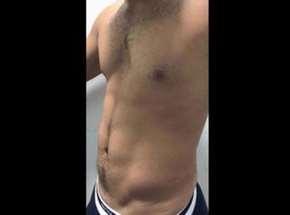 Liposucción - Dr. Carlos Zuleta Bechara