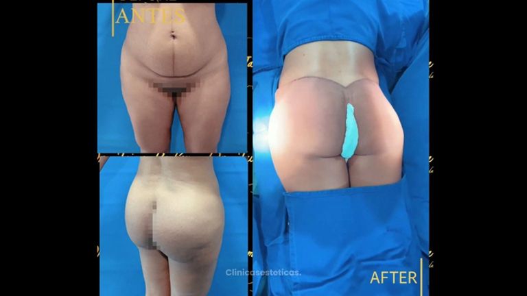 Gluteoplastia - Dr. Jaime Pachón