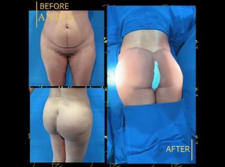Gluteoplastia - Dr. Jaime Pachón