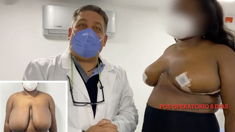 Mamoplastia de reducción - Dr. Hugo Javier Mejía Cuello
