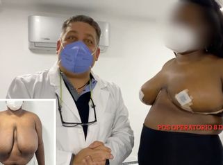 Mamoplastia de reducción - Dr. Hugo Javier Mejía Cuello