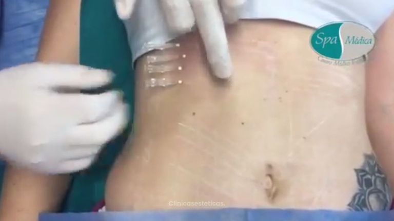 Hilos tensores abdomen.