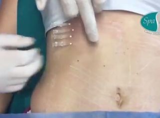 Hilos tensores abdomen.