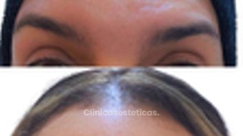 Toxina Botulínica - Doctora Alexandra Mora