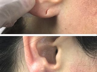 Lobuloplastia - Doctora Alexandra Mora