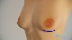 Mamoplastia de aumento retroglandular Mamoplastia de aumento retroglandular