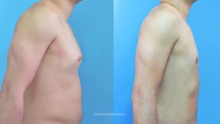 Ginecomastia Extirpación Liposucción Mamas Masculinas