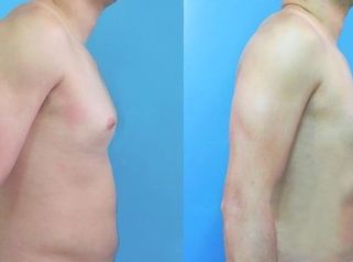 Ginecomastia Extirpación Liposucción Mamas Masculinas