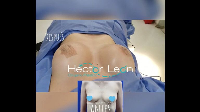 Mamoplastia de aumento - Dr. Héctor Guillermo León Higuera