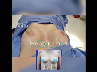 Mamoplastia de aumento - Dr. Héctor Guillermo León Higuera