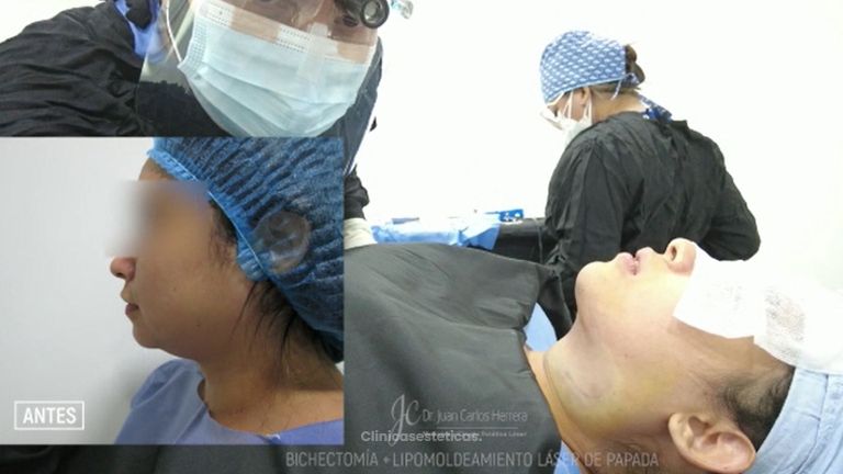 Bichectomía + Lipopapada - Dr. Juan Carlos Herrera P.