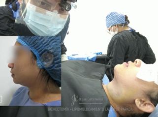 Bichectomía + Lipopapada - Dr. Juan Carlos Herrera P.