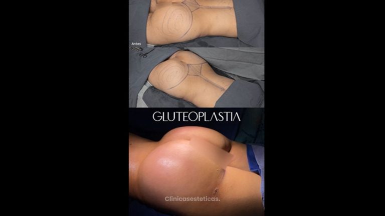 Resultados de varias Gluteoplastias - Dr. Luis Fernando Reyes y Dra. Nicole Echeverry