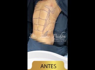 Marcaje abdominal - Dr. Jaime Pachón