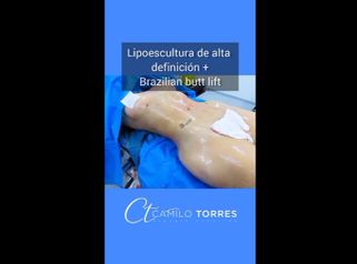 Lipoesculura - Dr. Camilo Rafael Torres Rodríguez