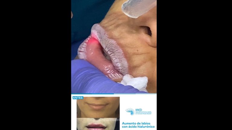 Aumento de labios - Dr. Fernando Pinedo Bischoff