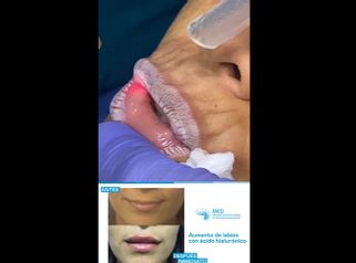 Aumento de labios - Dr. Fernando Pinedo Bischoff