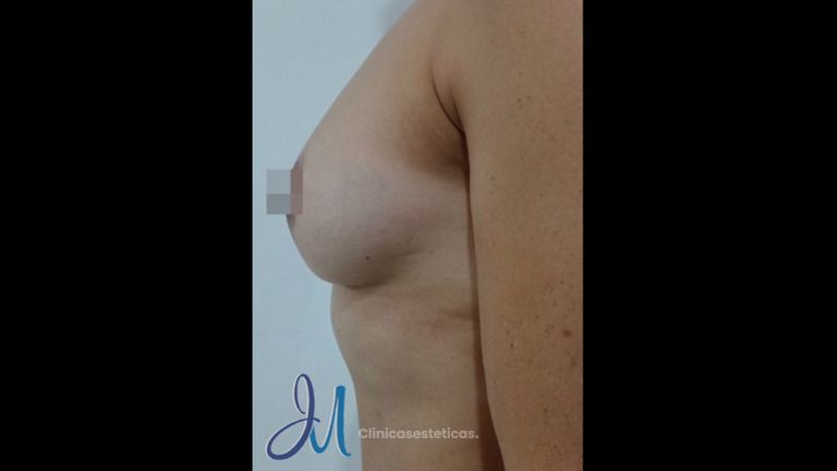Dr. José Miguel Sandoval tratamiento Mastopexia