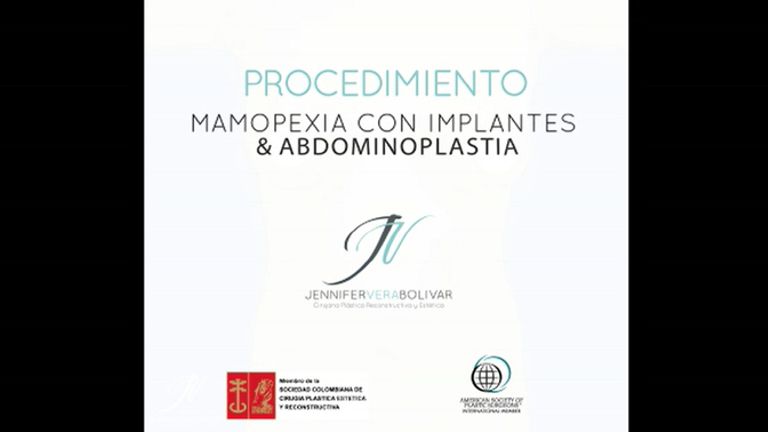 Mamopexia con implantes y abdominoplastia - Dra. Jennifer Vera Bolívar